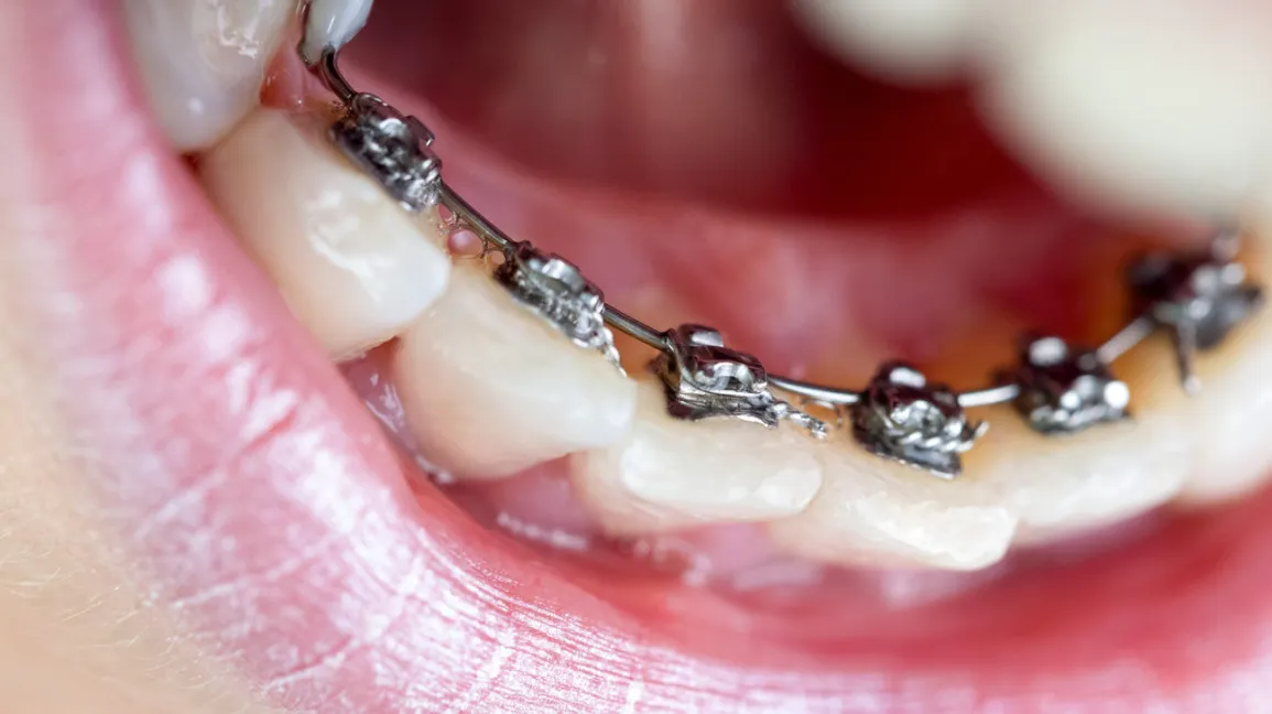 Read more about the article Pro Tips for Your First Month in Lingual Braces