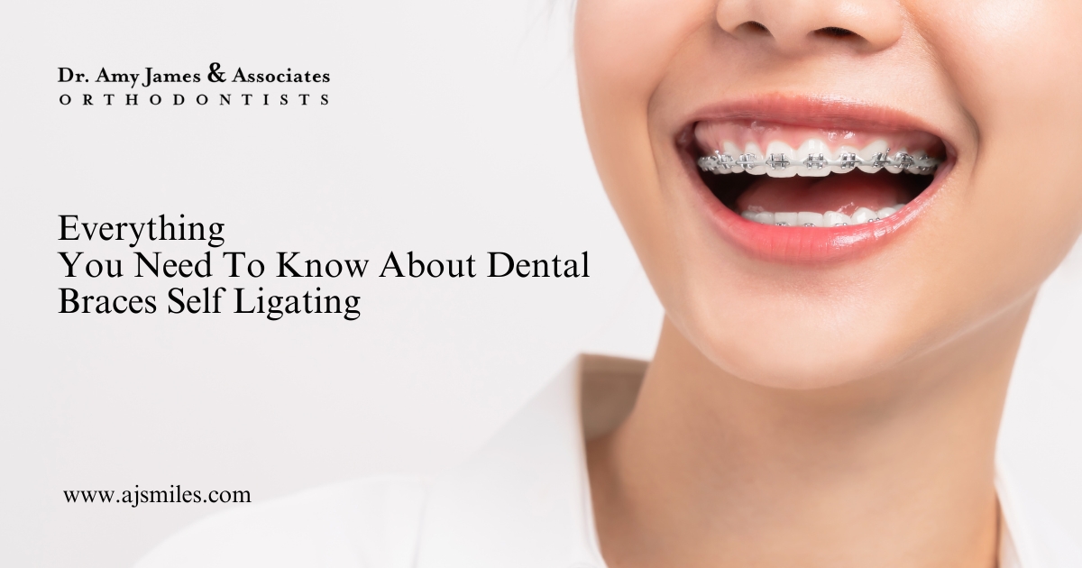 Read more about the article Everything You Need To Know About Dental Braces Self Ligating 