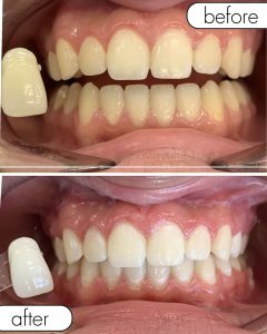 GLO Teeth Whitening Before and After