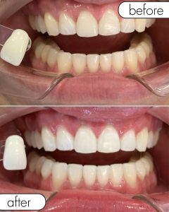 GLO Teeth Whitening Before and After