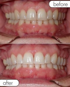 GLO Teeth Whitening Before and After