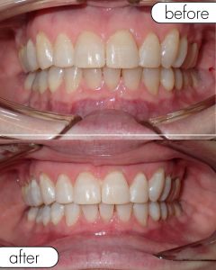GLO Teeth Whitening Before and After