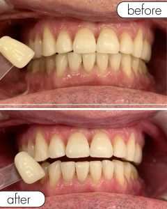 GLO Teeth Whitening Before and After