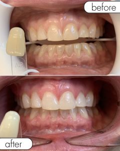 GLO Teeth Whitening Before and After
