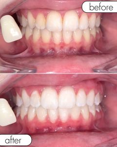 GLO Teeth Whitening Before and After