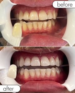 GLO Teeth Whitening Before and After