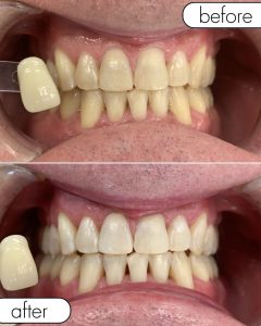 GLO Teeth Whitening Before and After