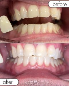 GLO Teeth Whitening Before and After