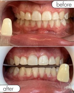 GLO Teeth Whitening Before and After