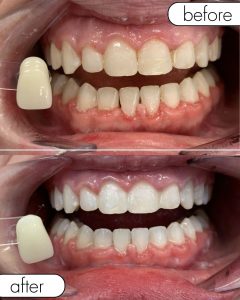 GLO Teeth Whitening Before and After
