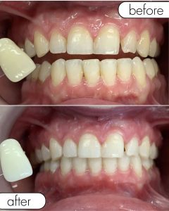 GLO Teeth Whitening Before and After