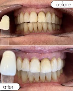 GLO Teeth Whitening Before and After
