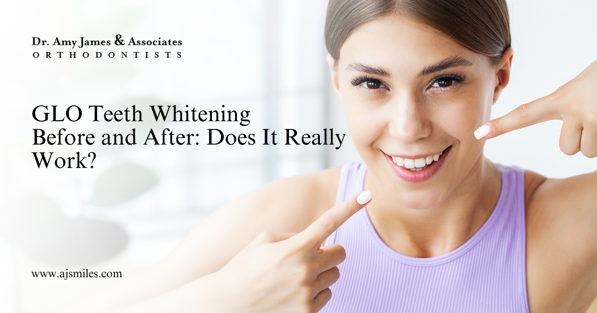 Read more about the article GLO Teeth Whitening Before and After: Does It Really Work?