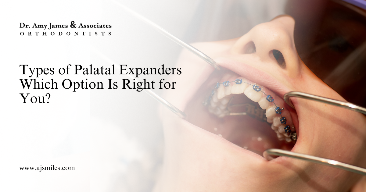 Read more about the article Types of Palatal Expanders: Which Option Is Right for You?