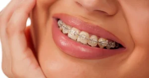 Benefits of Ceramic Braces for Adults