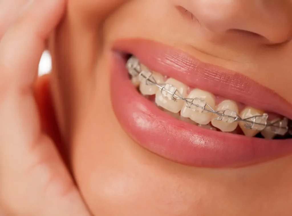 Clear Braces Aj Smiles