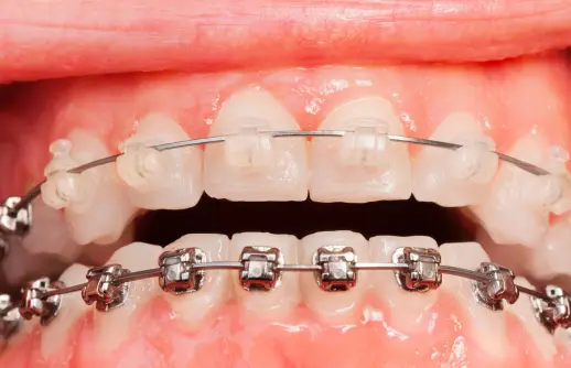 Clear Braces vs Metal​