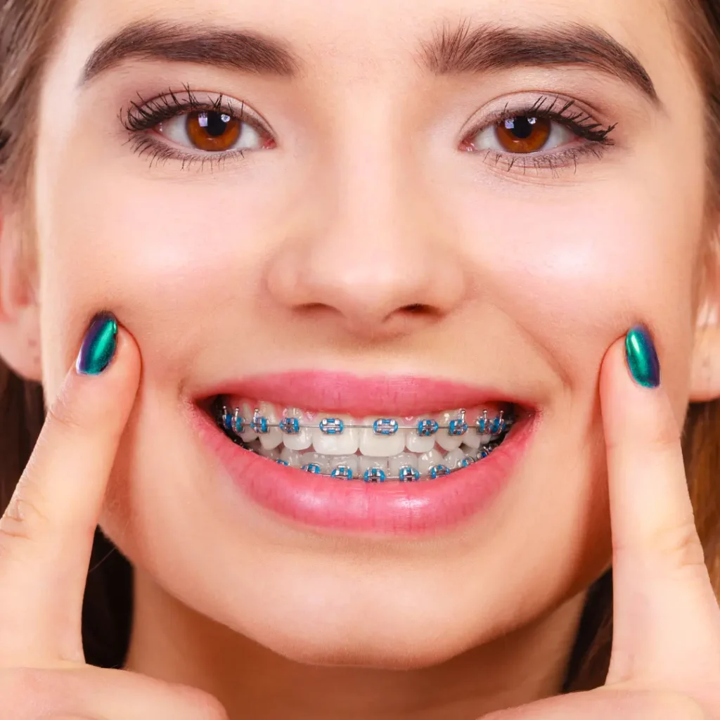 Braces vs Lingual Braces Cost