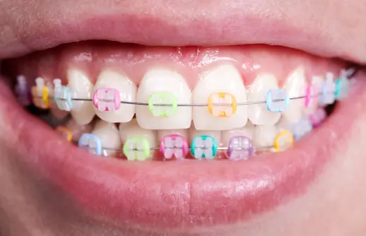 Color Braces for Teeth​