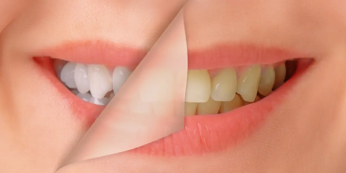 Read more about the article Glow White Teeth Whitening: The Most Effective Method to Get a Brilliant Smile