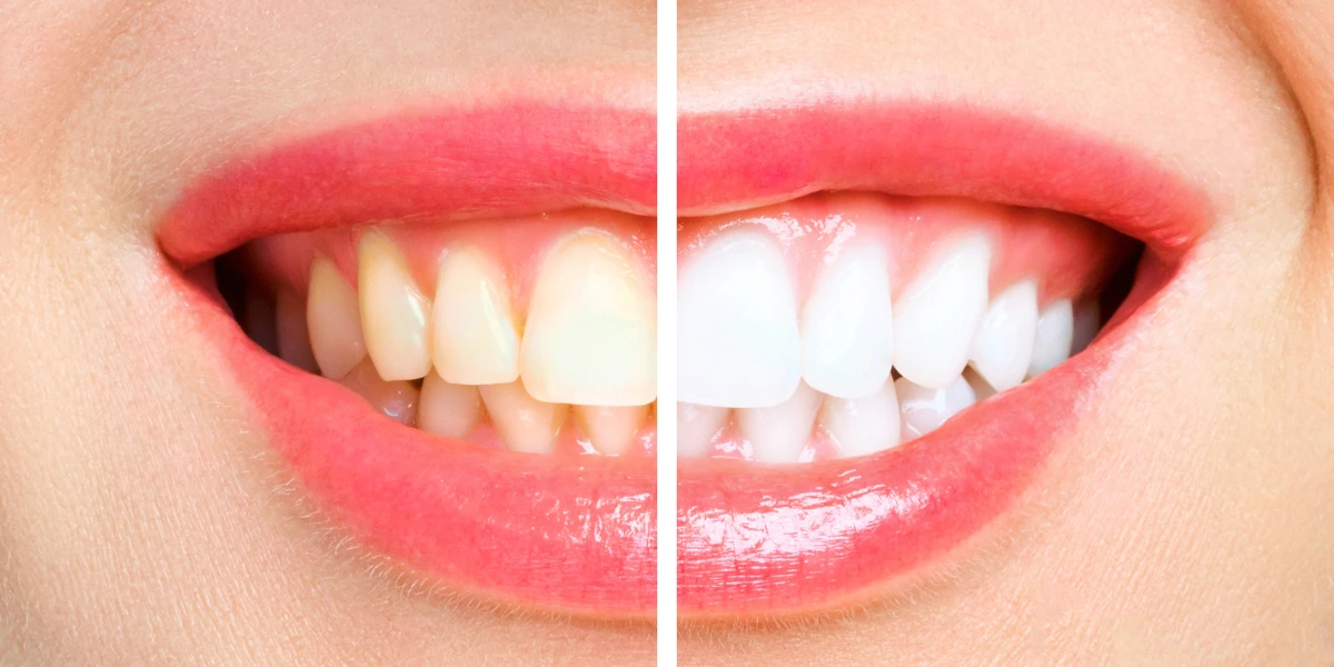 Glow White Teeth Whitening